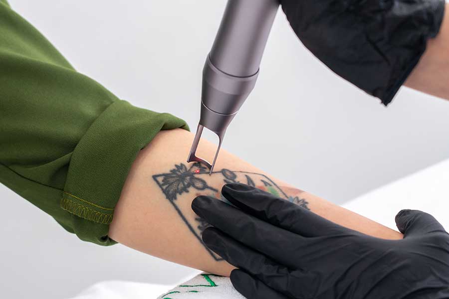 Détattouage au laser chez le dr Slodzian à Bordeaux
