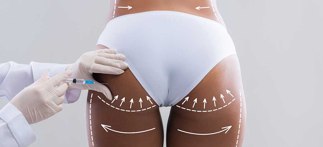 Augmentation fessière : Chirurgie (BBL, Implants) ou Injections ?